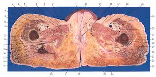 Its upper end or base, termed the femoral ring, is closed by extraperitoneal tissue known as the the muscles on the posterior thigh (biceps, semitendinosus, and semimembranosus) are known. Anatomy Atlases Atlas Of Human Anatomy In Cross Section Section 6 Pelvis Perineum Hip And Upper Thigh