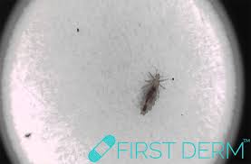 If you experience a tickling feeling on any part of your body, you need to check out for lice. Head Lice Infestation Online Dermatology