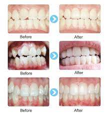 Teeth Braces Low Cost Teeth Straightener Teeth Alignment Etsy In 2021 Teeth Straightening Teeth Alignment Teeth Braces