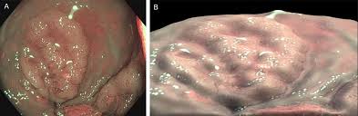 Image result for Virtual Endoscopy