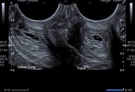 We did not find results for: Cervical Ectopic Pregnancy Radiology Reference Article Radiopaedia Org