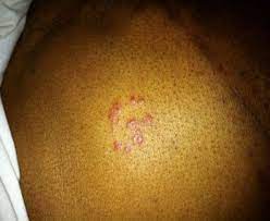 Type pain in my glans.so far two igg,igm blood test are negative and one more blood test the method is western blot but not sure it is the same which is done by university of washington hsv2 western. Herpes Virus Infections After Lung Transplant Consult Qd