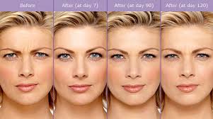 Conservative doses of botox result in movement returning to the muscle more quickly than heavier doses. Botox Dr Quardt Medical Spa Rancho Mirage Palm Springs Palm Desert