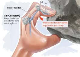 Flexor tendon injuries are some of the more common injuries, but yet complex injuries managed by hand surgeons. Finger Injuries And Climbing Bouldercentre For Orthopedics Spine