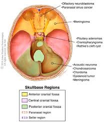 Overview, anterior skull base, middle skull base march 18, 2017. Types Of Skull Base Tumors And Conditions Johns Hopkins Skull Base Tumor Center