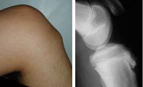 Osgood Schlatter S Disease Tibial Tubercle Apophysitis Knee Sports Orthobullets