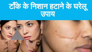 The cost can vary, but expect to pay in the range of $600 or more out of pocket. How To Remove Stitches Marks In Home Remedy à¤ à¤ à¤ à¤¨ à¤¶ à¤¨ à¤¹à¤ à¤¨ à¤ à¤à¤° à¤² à¤à¤ª à¤¯ Youtube