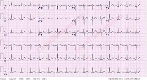 Image result for Q Wave