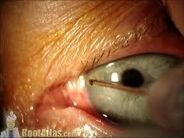 Image result for Eye Foreign Body