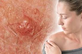 The older you are, the greater your risk. Skin Cancer Symptoms Warning Signs Your Mole Is Melanoma How To Prevent It Express Co Uk