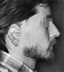 Ohrmuschelverletzungen 3.3.1 Bissverletzungen