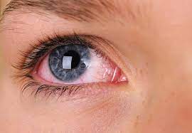Feb 17, 2021 · by ernie mundell and robert preidt healthday reporters. How Does Covid 19 Affect The Eyes West Broward Eyecare Associates Optometry