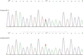 We did not find results for: The Clinical Feature Of Myocilin Y437h Mutation In A Chinese Family With Primary Open Angle Glaucoma British Journal Of Ophthalmology