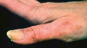 Acral lentiginous melanoma is notorious for going undetected because it appears like a normal, dark patch of skin so keep an eye on any new areas of pigment changes. Melanoma