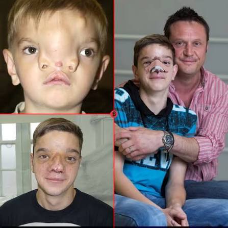 He was born with a severe facial deformity known as a medium facial cleft,  which displaced his eyes and prevented him from having a formed nose, but  Stefan Savic's life changed radically