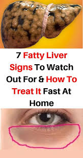 Fatty Liver Symptoms Sings To Watch Out For And How To Treat It Fast At Home Fatty Liver Fatty Liver Symptoms Fatty Liver Disease