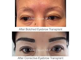 In some cases (injuries, burns by transplanting you can achieve natural eyebrow growth. Corrective Eyebrow Transplant Marc Dauer Md Hair Transplant Doctor Los Angeles
