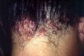 Image result for sores on the head in children