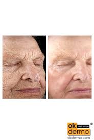 Unleash Face Radiance: A-Ret® Tretinoin Skin Gel