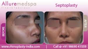 Septoplasty Is Also Known As Deviated Septum Rhinoplasty That Designed To Correct The Shape Of The Septum Of The Rhinoplasty Surgery Nose Reshaping Rhinoplasty