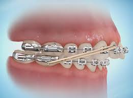 We did not find results for: What Are Orthodontic Elastics Rubber Bands And How Do They Work Affordable Braces Jorgensen Orthodontics