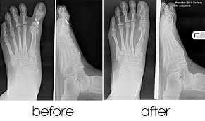 Image result for Hallux Varus