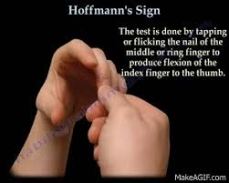 Hyperreflexia clonus positive hoffman 39 s sign central cervical spine stenosis. Hoffmann S Sign Everything You Need To Know Dr Nabil Ebraheim On Make A Gif