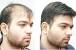 Short Hairstyles For Alopecia