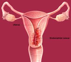 Rahim lenfleri ile ilgili sorular, makaleler ve videolar uzman doktorlar tarafından hazırlanıyor. Endometrium Rahim Kanseri Belirtileri Ve Tedavi Secenekleri Doc Dr Serap Yalti Bodrum Kadin Hastaliklari Ve Dogum Uzmani