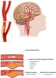 Image result for carotid artery