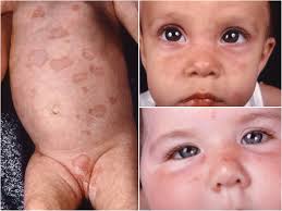 Neonatal Systemic Lupus Erythematosus Syndrome: a Comprehensive Review