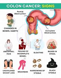 Image result for Constipation in Cancer