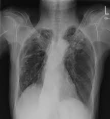 The lungs are the most common site of primary infection by tuberculosis and are a major source of spread of the disease and of individual morbidity and mortality. Tuberculosis Healed Post Secondary Radiology Case Radiopaedia Org