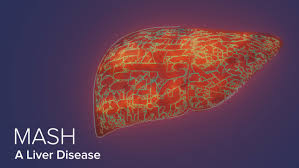 MASH (Formerly NASH): Understanding This Form of Fatty Liver Disease | News  | Yale Medicine