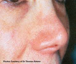 Red moles, or cherry angiomas, are common skin growths that can develop on most areas of your body. Cherry Angiomas Laser Treatments Dermatologist Dr Gergana Gallacher Dermatology And Laser Centre