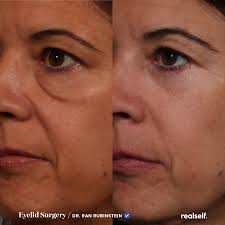 What Really Goes Into An Eyelid Lift Eye Lift Surgery Eye Bag Surgery Eyelid Lift