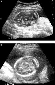 Measurement Of Nuchal Skin Fold Thickness In The Second