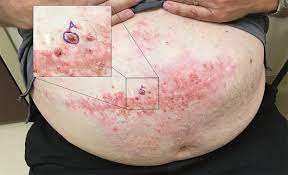 This transformation occurs within about two years, before another mutation can develop. Cutaneous Colon Cancer Metastases In A Surgical Scar Nejm