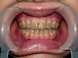 Image result for Tooth Discoloration