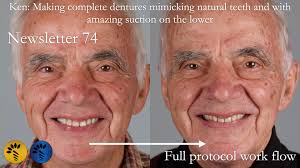 📢 Transforming Smiles: Ken's Complete Denture Journey 🦷 Join me for an  exclusive Study Club Live Webinar