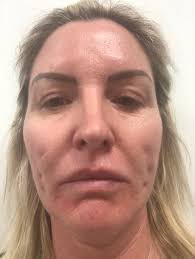 Have my threads been pulled too tight