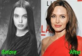 The actress has never confirmed that she's gotten a nose job, but multiple plastic surgeons have said that it looks like she's had a rhinoplasty . Angelina Jolie Rhinoplasty 35 Images Plastic Surgery Before And After Nose Pin On Beautiful Plastic Plastic Surgery Nose Chin Implant Facelift