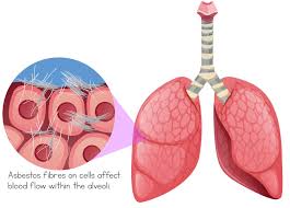 In rare cases, the asbestos fibers make their way to the. What Does Asbestos Do To You Affects Of Exposure Risk Health Impact