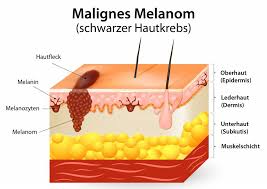 Das maligne melanom entwickelt sich aus pigmentierten zellen (melanozyten), die natürlicherweise in haut und schleimhaut vorhanden sind. Hautkrebs Malignes Melanom