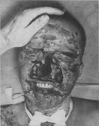 Facts you should know about mucormycosis (zygomycosis). Mucormycosis In Severely Burned Patients Report Of Two Cases With Extensive Destruction Of The Face And Nasal Cavity Nejm