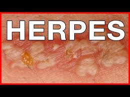 The herpes simplex virus (hsv) can cause blisters and sores almost anywhere on the skin. Genital Herpes Symptoms And Treatment