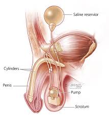 28/11/2019 by dr simran deo. Erectile Dysfunction Ed Symptoms Diagnosis Treatment Urology Care Foundation