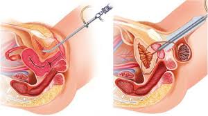 Blasenspiegelung Zystoskopie Ablauf Diagnose