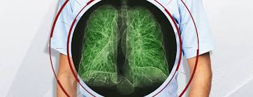 The california technology assessment forum is requested to review the scientific evidence for the use of low dose spiral computerized tomography (ldct) as a modality for lung cancer screening. Low Dose Ct Lung Cancer Screening Ldct Maryland