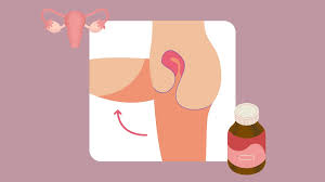 Image result for Uterine Inversion